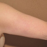 Arm Lift - Before and After Pictures