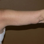 Arm Lift - Before and After Pictures