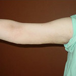Arm Lift - Before and After Pictures