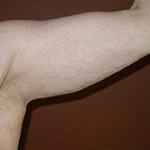 Arm Lift - Before and After Pictures