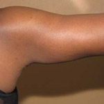 Arm Lift - Before and After Pictures