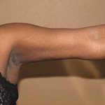 Arm Lift - Before and After Pictures