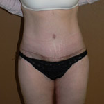 Belt Lipectomy - Before And After Pictueres