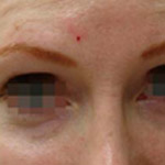 Botox - Before And After Pictueres