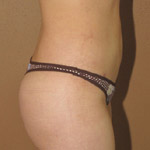 Brazilian Buttock Lift - Before And After Pictueres