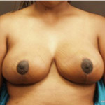 Breast Reduction - Before And After Pictueres