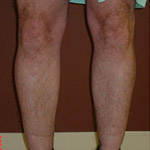 Calf Augmentation - Before And After Pictueres