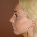 Chin Augmentation - Before And After Pictueres