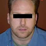 Chin Augmentation - Before And After Pictueres