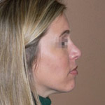 Chin Augmentation - Before And After Pictueres