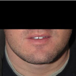 Chin Augmentation - Before And After Pictueres