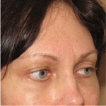 Forehead Brow Lift - Before And After Pictueres