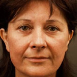 Forehead Brow Lift - Before And After Pictueres