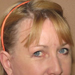 Forehead Brow Lift - Before And After Pictueres