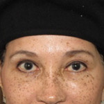 Forehead Brow Lift - Before And After Pictueres