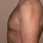 Gynecomastia Correction - Before And After Pictueres