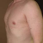 Gynecomastia Correction - Before And After Pictueres