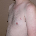 Gynecomastia Correction - Before And After Pictueres