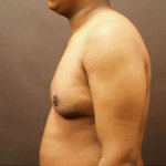 Gynecomastia Correction - Before And After Pictueres