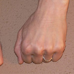 Hand Rejuvenation - Before And After Pictueres