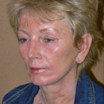 Laser Resurfacing - Before And After Pictueres