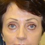 Laser Resurfacing - Before And After Pictueres