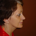 Laser Resurfacing - Before And After Pictueres