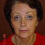 Laser Resurfacing - Before And After Pictueres
