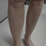 Laser Vein Removal - Before And After Pictueres