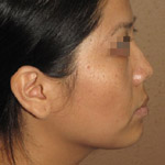 Liposuction - Before And After Pictueres