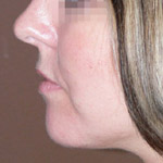 Liposuction - Before And After Pictueres