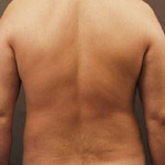Liposuction - Before And After Pictueres
