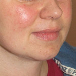 Liposuction - Before And After Pictueres