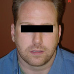 Liposuction - Before And After Pictueres