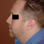 Liposuction - Before And After Pictueres