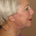 Mid Face Lift - Before And After Pictueres