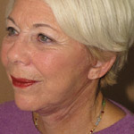 Mid Face Lift - Before And After Pictueres