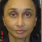 Mid Face Lift - Before And After Pictueres