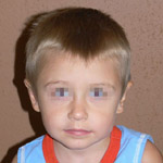 Otoplasty - Before And After Pictueres