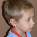 Otoplasty - Before And After Pictueres