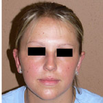 Otoplasty - Before And After Pictueres