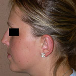 Otoplasty - Before And After Pictueres