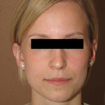 Otoplasty - Before And After Pictueres