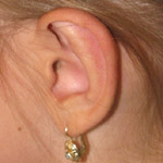 Otoplasty - Before And After Pictueres