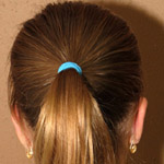 Otoplasty - Before And After Pictueres