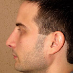 Rhinoplasty - Before And After Pictueres