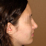 Rhinoplasty - Before And After Pictueres