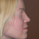 Rhinoplasty - Before And After Pictueres