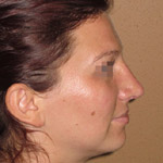 Rhinoplasty - Before And After Pictueres