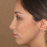 Rhinoplasty - Before And After Pictueres